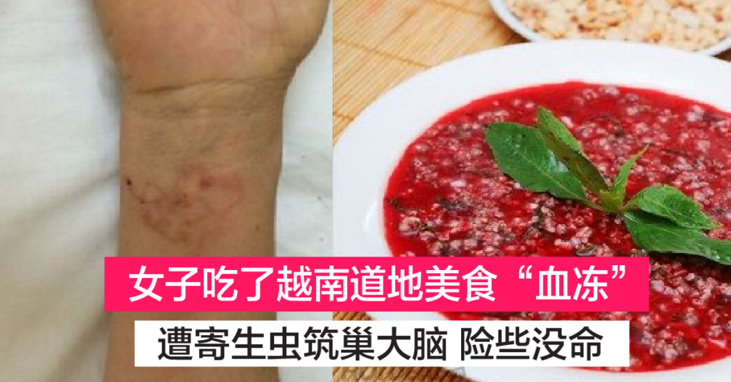 越南妇女吃了食物”血冻“竟遭大量寄生虫筑巢在脑 还爬到皮肤组织下！